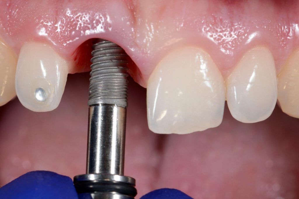 Beneficios de implante dental